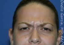 before brows down view botox of female patient 3204
