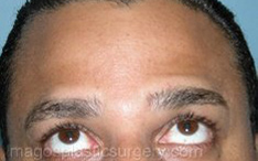 after brows up view botox of male patient 3211