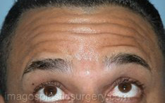 before brows up view botox of male patient 3211