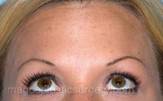 after brows up view botox of female patient 3214