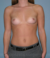 before front view breast augmentation of female patient 3086