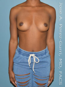 before front view breast augmentation of female patient 3107