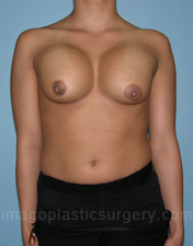 before front view breast implant revision of female patient 3343
