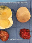 female patient 3440 previous breast implants