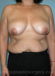 Before breast lift front view case 3921