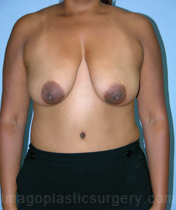 Before breast lift front view case 3940