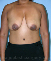 Before breast lift front view case 3940
