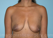 Before breast lift front view case 3945