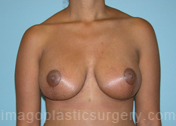 AFter breast lift front view case 3945