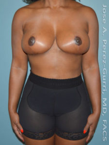 After breast lift front view case 3961