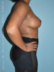 After breast lift right side case 3961