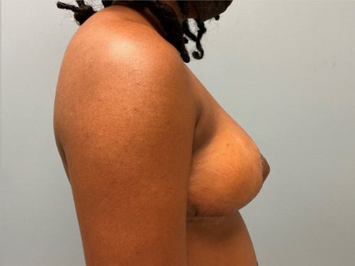 After breast lift right side case 3966