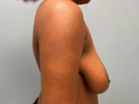 Before breast lift right side case 3966