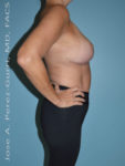 After breast lift right side case 3976