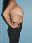 Before breast lift right side case 3976