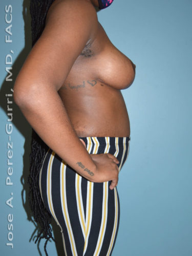 After breast lift right side case 3987