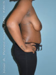 Before breast lift right side case 3987
