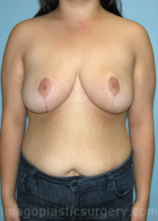 After breast reduction front view case 4146