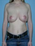 After breast reduction front view case 4167