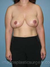 After breast reduction front view case 4173