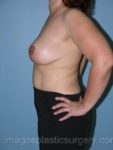 After breast reduction left side view case 4173