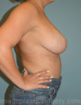 Before breast reduction right side view case 4179