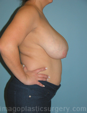 Before breast reduction right side view case 4179