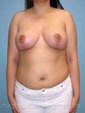 After breast reduction front view case 4184