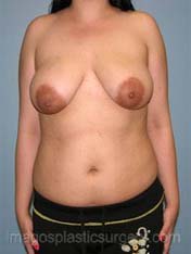 Beforebreast reduction front view case 4184