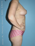 After breast reduction right side view case 4199