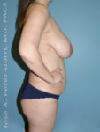 Before breast reduction right side view case 4199