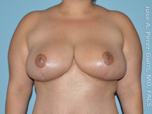 After breast reduction front view case 4204