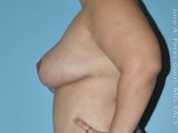 After breast reduction left side view case 4204