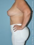 After breast reduction left side view case 4214