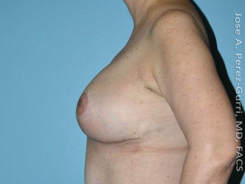 After breast reduction left side view case 4220