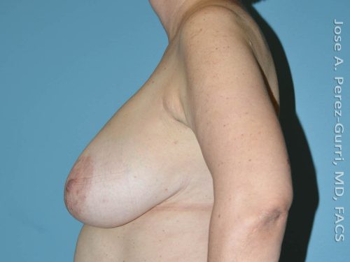 Before breast reduction left side view case 4220