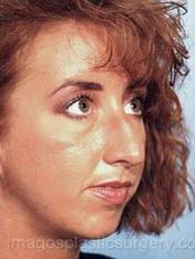 before right angle view chin augmentation of female patient 2529
