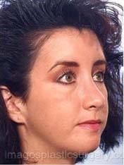 after right angle view chin augmentation of female patient 2529