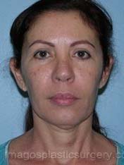before front view chin augmentation of female patient 2532