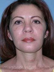 after front view chin augmentation of female patient 2532