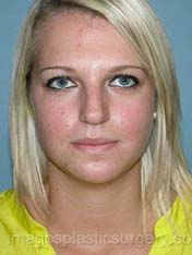 after front view chin augmentation of female patient 2537