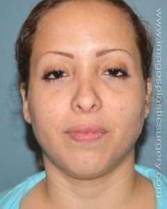 before front view chin augmentation of female patient 2543