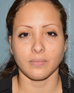 after front view chin augmentation of female patient 2543