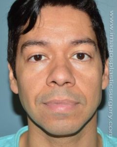 before front view chin augmentation of male patient 2548