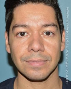 after front view chin augmentation of male patient 2548
