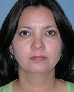 before front view chin augmentation of female patient 2553