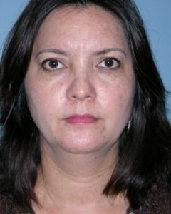 after front view chin augmentation of female patient 2553