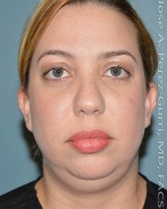 before front view chin augmentation of female patient 2566