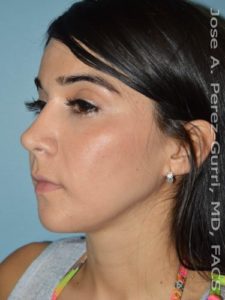 after left angle view chin augmentation of female patient 2571