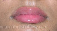 After dermal fillers female patient case 4000